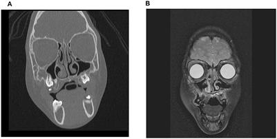 Silent Sinus Syndrome and Williams Syndrome: Two Rare Diseases Found in a Pediatric Patient